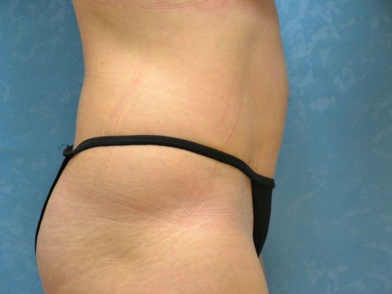 Tummy Tuck: Case 1678- Metamora, OH - After