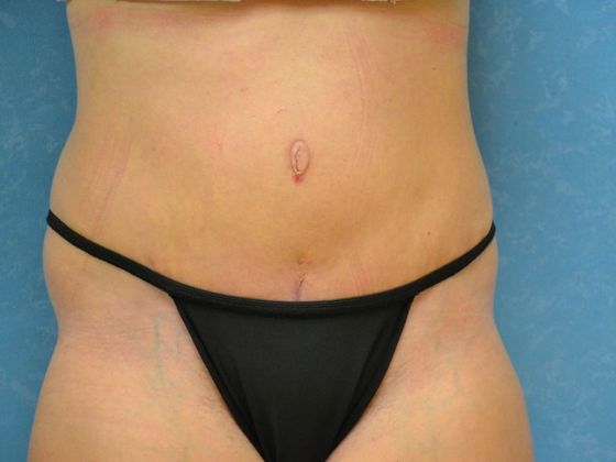 Tummy Tuck: Case 1678- Metamora, OH - After