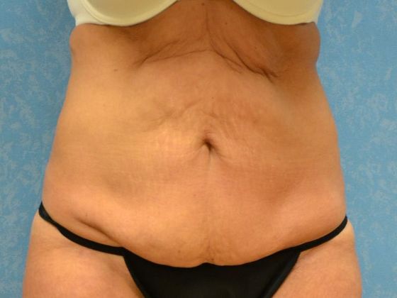 Tummy Tuck: Case 1679- Tontogany, OH - Before