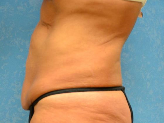 Tummy Tuck: Case 1679- Tontogany, OH - Before