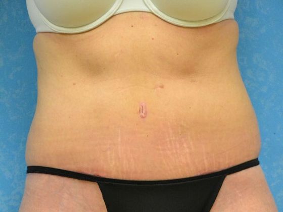 Tummy Tuck: Case 1679- Tontogany, OH - After
