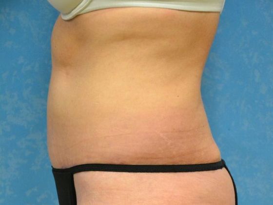 Tummy Tuck: Case 1679- Tontogany, OH - After