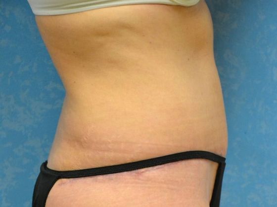 Tummy Tuck: Case 1679- Tontogany, OH - After