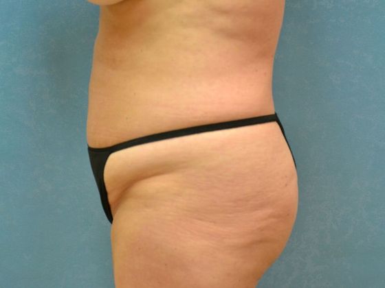 Tummy Tuck: Case 1680- Sylvania, OH - Before