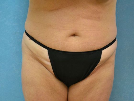 Tummy Tuck Case 1680- Sylvania, OH - Before