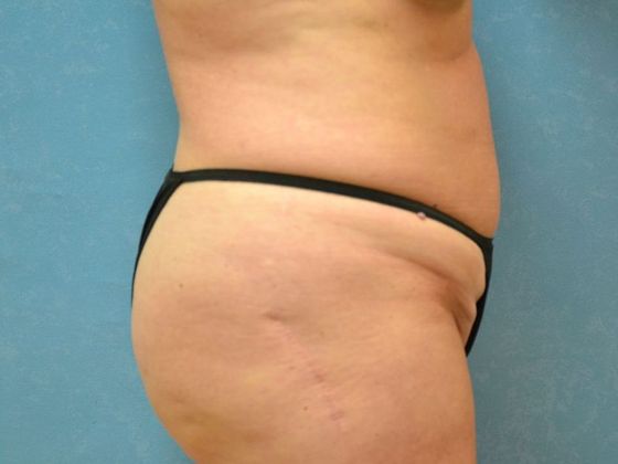 Tummy Tuck: Case 1680- Sylvania, OH - Before
