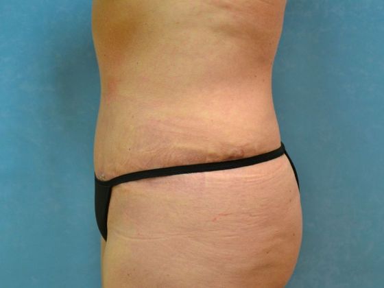 Tummy Tuck: Case 1680- Sylvania, OH - After