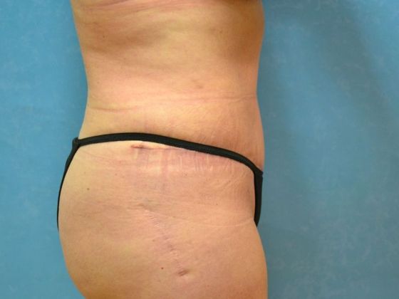 Tummy Tuck: Case 1680- Sylvania, OH - After