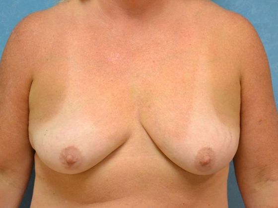 Breast Lift Case 1442- Sylvania, OH - Before