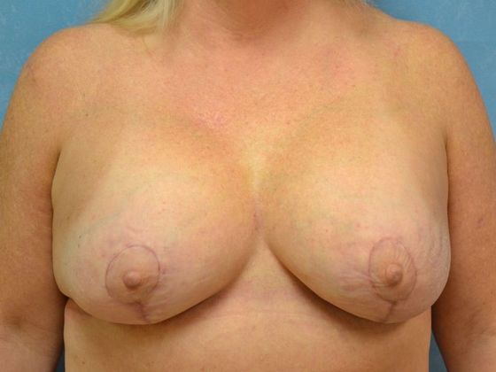 Breast Lift Case 1442- Sylvania, OH - After