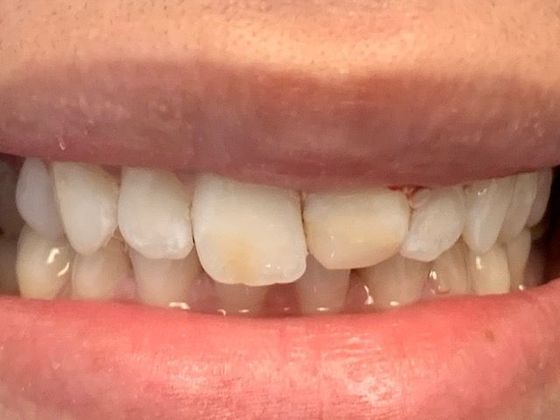 Porcelain Dental Crowns Case 6 - Before