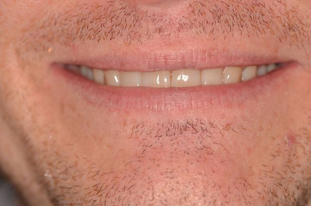Porcelain Veneers: Case 21 - Before with worn teeth