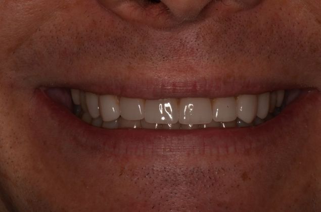 Porcelain Veneers: Case 21 - After with veneers