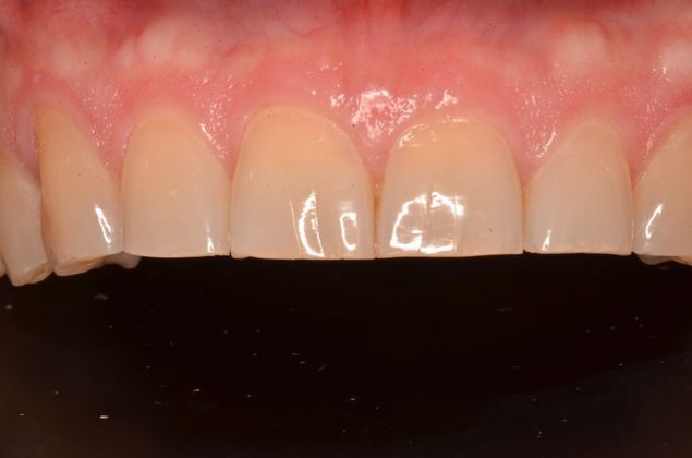Porcelain Veneers: Case 21 - Before restorations