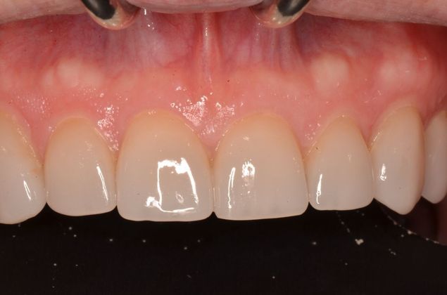 Porcelain Veneers: Case 21 - After porcelain restorations