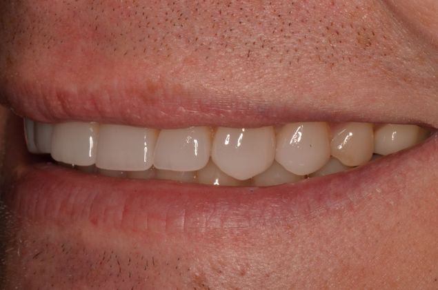 Porcelain Veneers: Case 21 - After Veneers