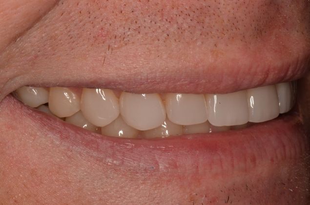Porcelain Veneers: Case 21 - After Veneers