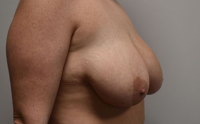 Breast Lift (Mastopexy): Case 81 - Before