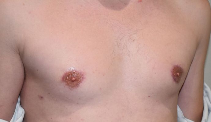Gynecomastia: Case 2 - After