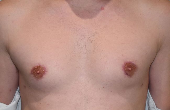 Gynecomastia Case 2 - After