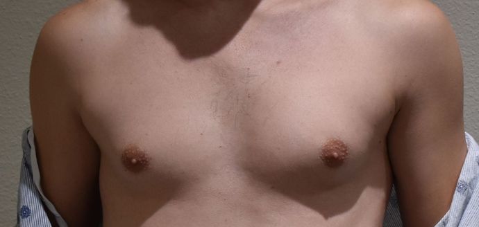 Gynecomastia Case 2 - Before