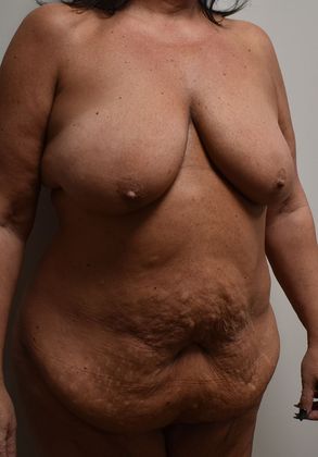 Mommy Makeover: Case 143 - Before