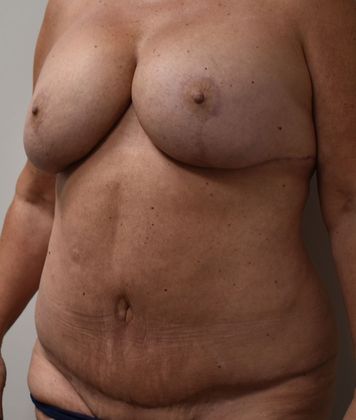 Massive Weight Loss : Case 60 - After