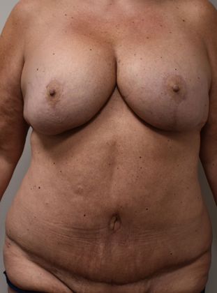 Massive Weight Loss : Case 60 - After