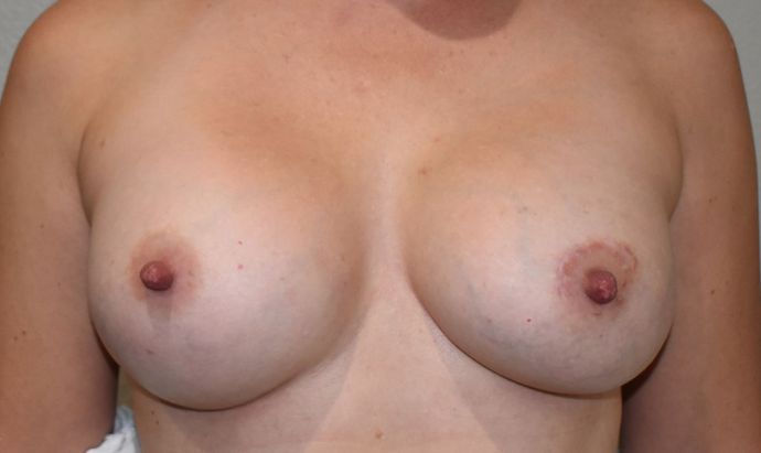 Breast Augmentation Case 577 - After