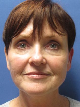 Facelift / RestoreLift: Case 3 - Before