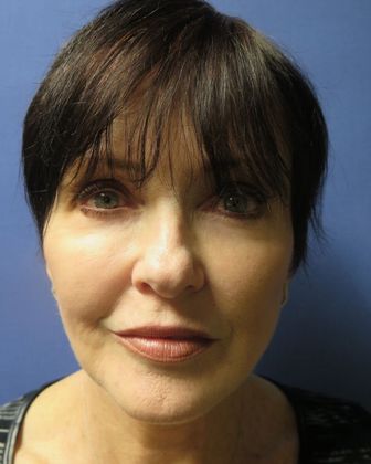 Facelift / RestoreLift: Case 3 - After