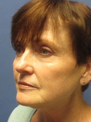 Facelift / RestoreLift Case 3 - Before