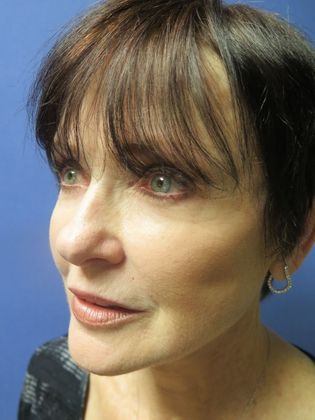 Facelift / RestoreLift Case 3 - After