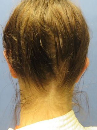 Otoplasty Case 1 - After