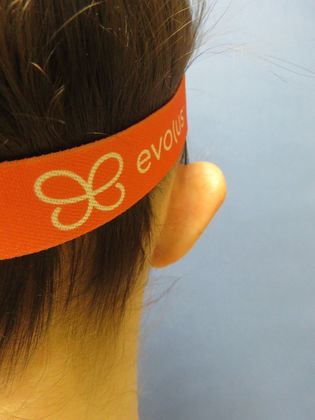 Otoplasty: Case 1 - After