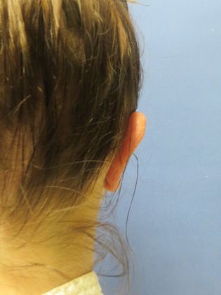 Otoplasty: Case 1 - Before