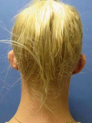 Otoplasty Case 2 - Before