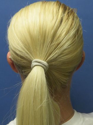 Otoplasty Case 2 - After