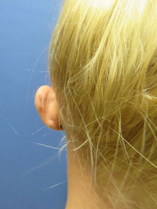 Otoplasty: Case 2 - Before