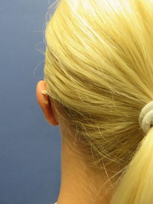 Otoplasty: Case 2 - After