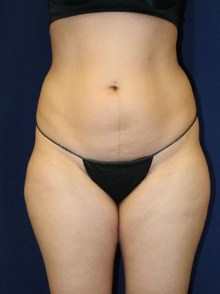 Liposuction & Safe Lipo: Case 40 - Before