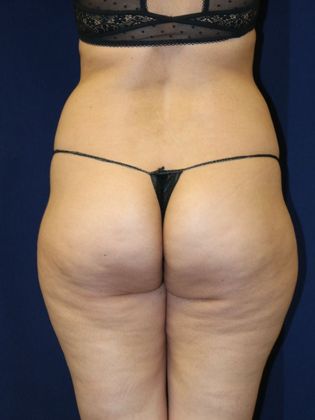 Liposuction & Safe Lipo: Case 40 - Before
