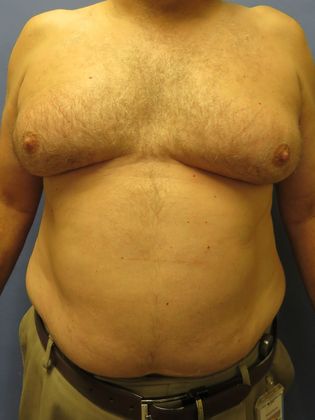 Gynecomastia Surgery (Male Breast Reduction Surgery) Case 15 - Before