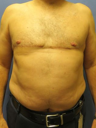 Gynecomastia Surgery (Male Breast Reduction Surgery) Case 15 - After