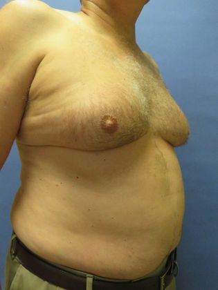 Gynecomastia Surgery (Male Breast Reduction Surgery): Case 15 - Before