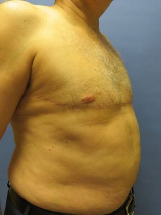 Gynecomastia Surgery (Male Breast Reduction Surgery): Case 15 - After