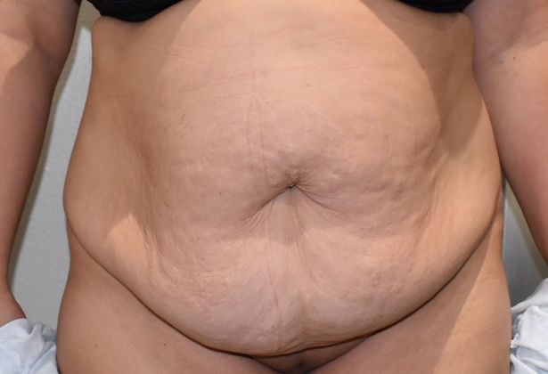 Tummy Tuck (Abdominoplasty): Case 210 - Before