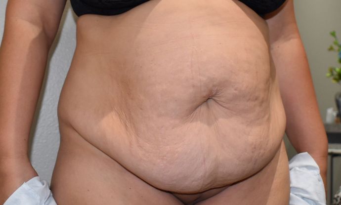 Tummy Tuck (Abdominoplasty): Case 210 - Before