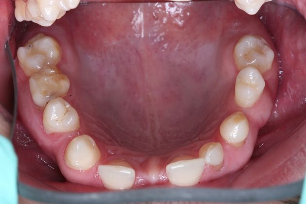 Full Mouth Rehabilitation: Samir - Before