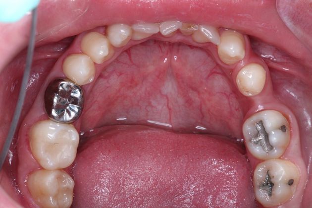 Full Mouth Rehabilitation: Samir - Before